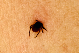 A tick with its head buried in someone's skin (Photo by falconpoule CC BY-NC)